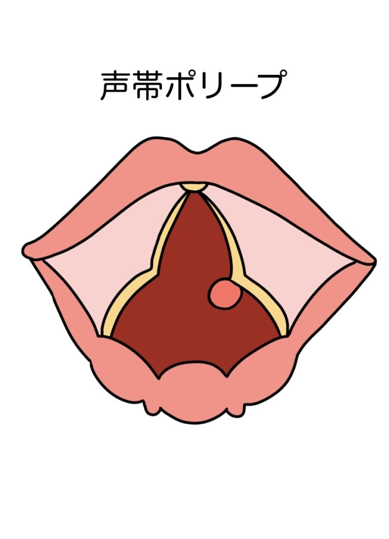 「声がかすれる…」声帯ポリープ・声帯結節の症状と対処法 | そら鍼灸院